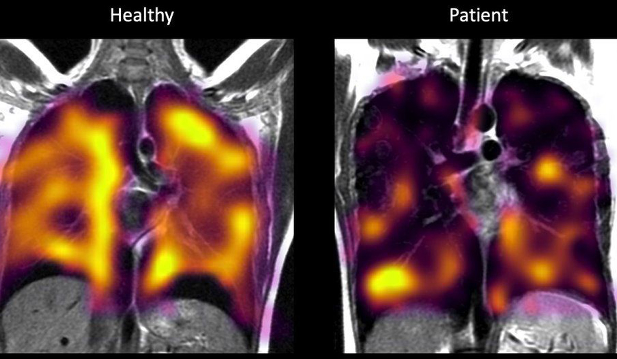 Hidden lung damage spotted on scans